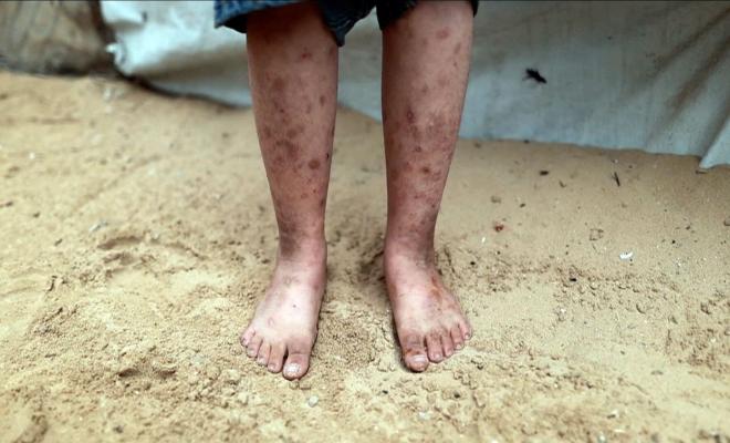 غزة – 17 ألف حالة إصابة مرتبطة بالقوارض