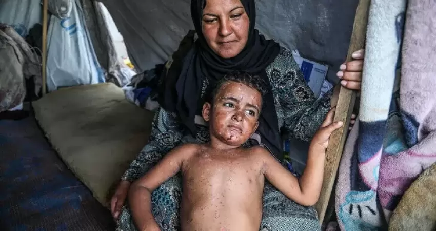 أبو سلمية: 5 آلاف إصابة جلدية أسبوعياً ووفيات يومية لمرضى السرطان بمجمع الشفاء