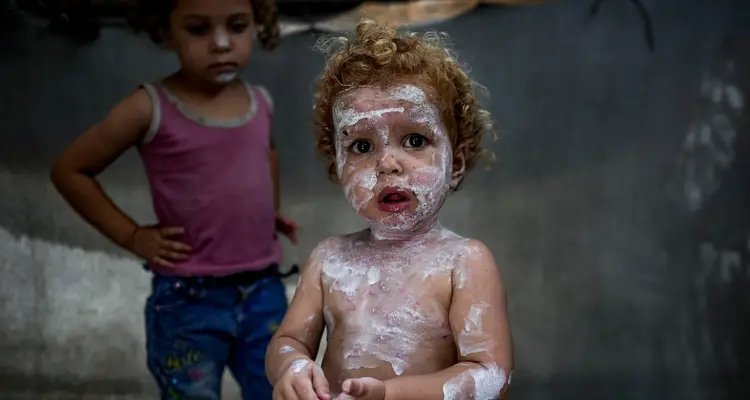 سوء التغذية والأنيميا والجرب.. أمراض تفتك بأطفال غزة